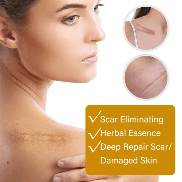 Acne Scar Removal Rejuvenation Serum | Scar, C Section & Stretch Mark Removal Oil For Women